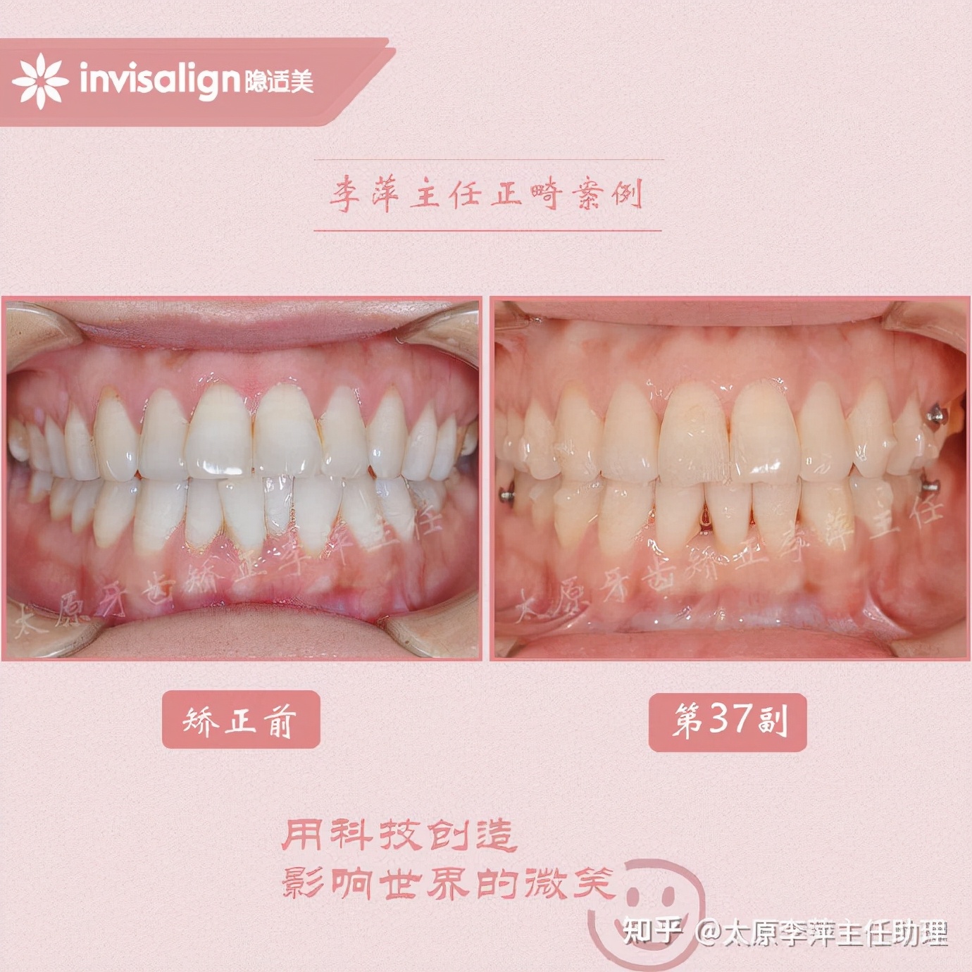 太原牙齿矫正：隐形牙套效果好不好？看这些病例你就知道了