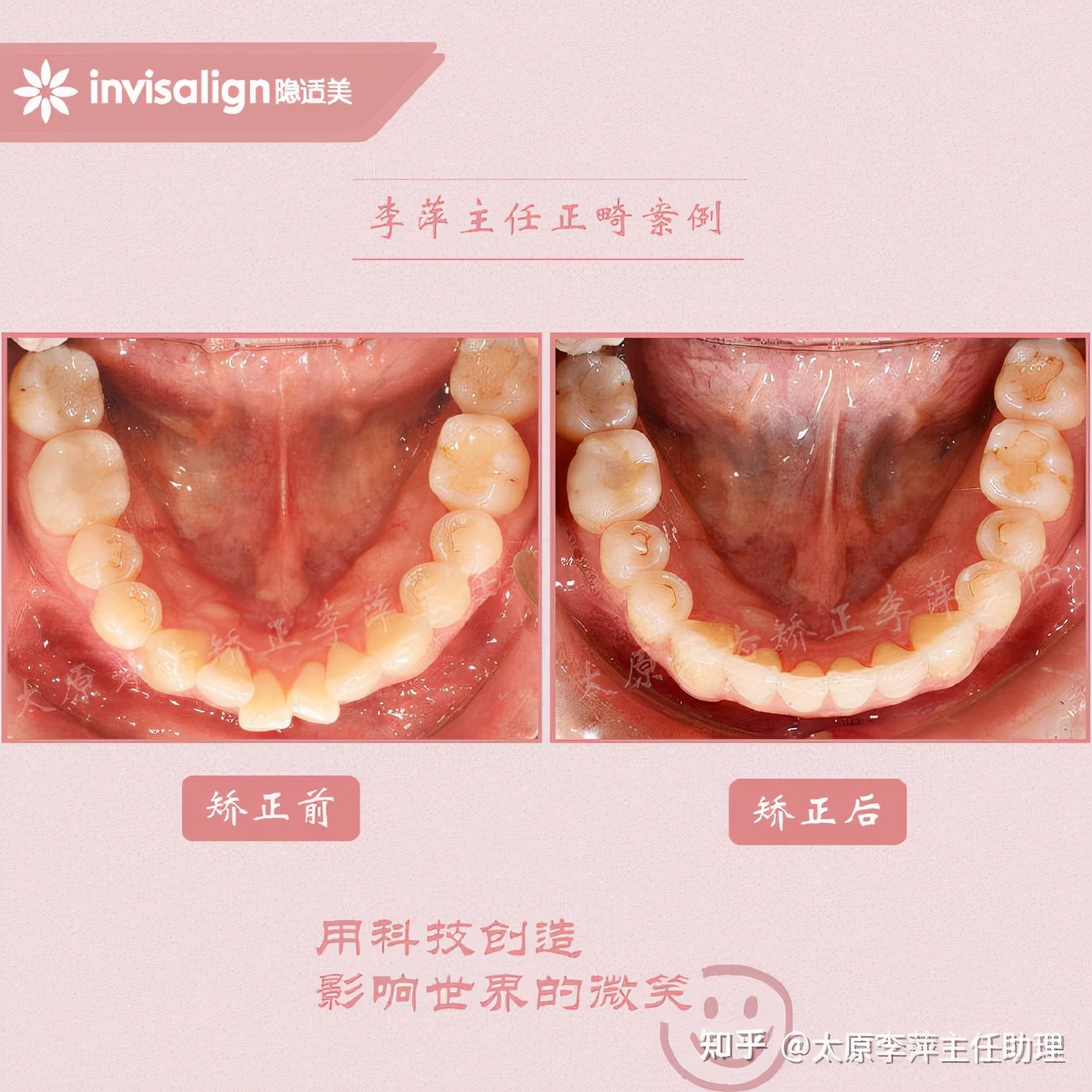 太原牙齿矫正：隐形牙套效果好不好？看这些病例你就知道了
