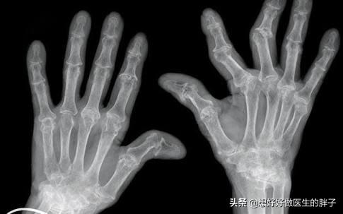 辟谣i膝盖有骨刺使劲走就能磨掉?天方夜谭!医生告诉您该怎么办