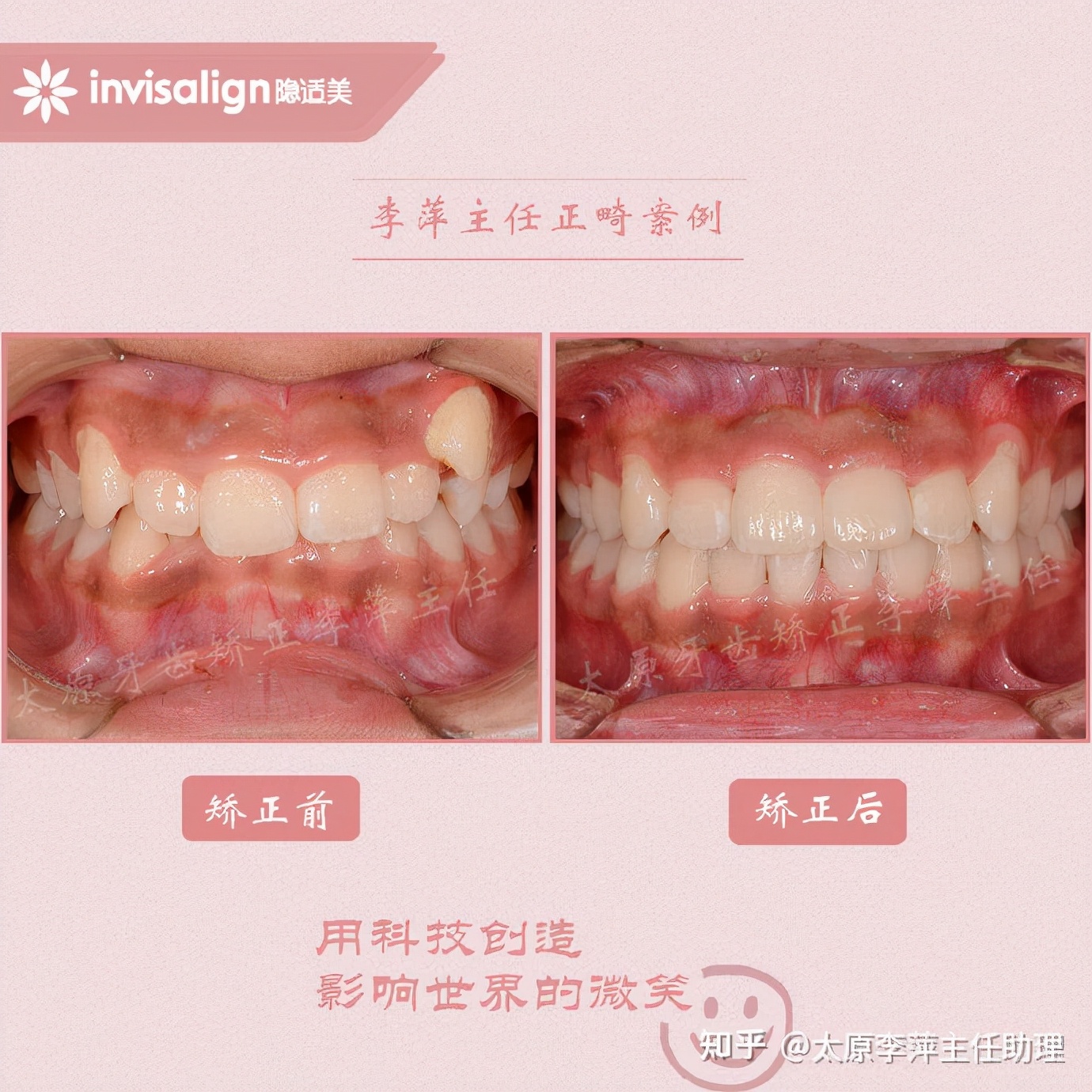 太原牙齿矫正：隐形牙套效果好不好？看这些病例你就知道了