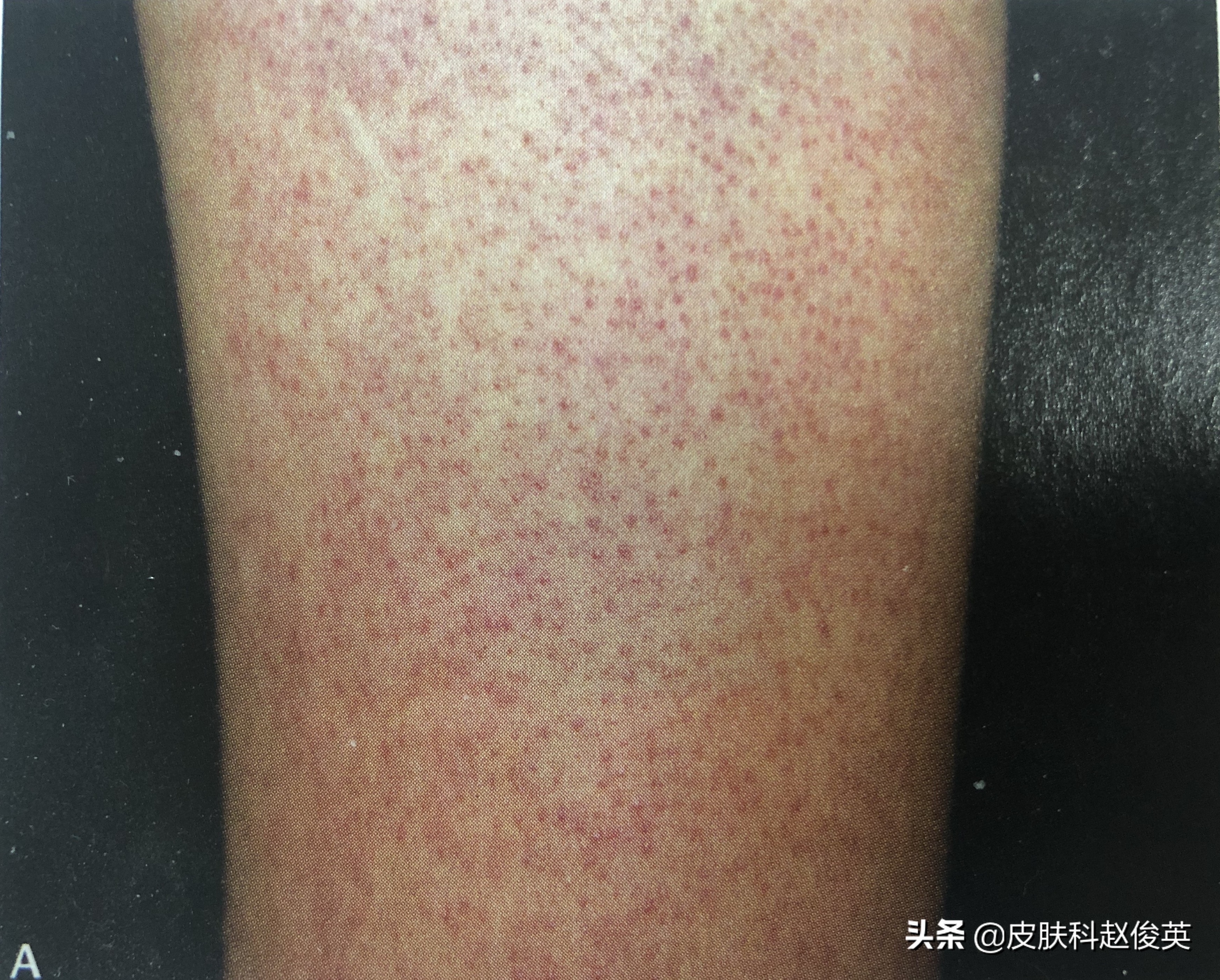 附鸡皮肤治疗攻略