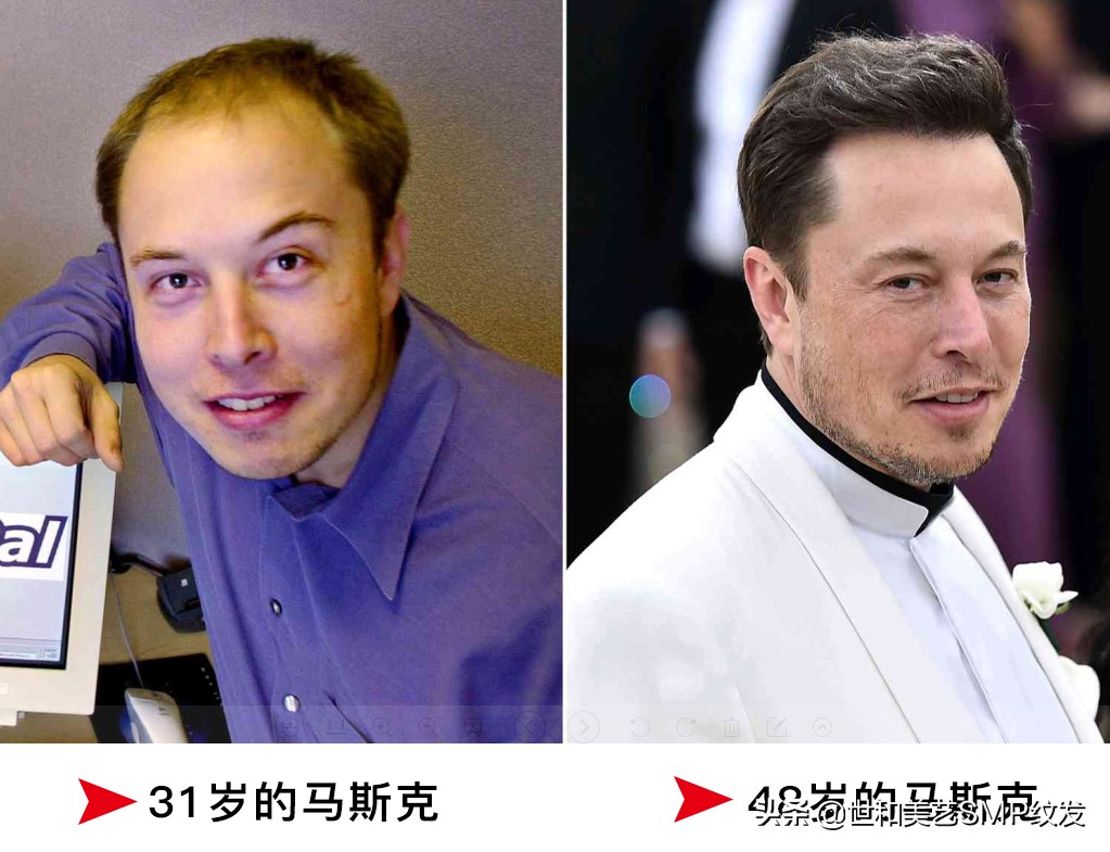 埃隆马斯克植发成功了,但秃顶的你也许更适合纹发