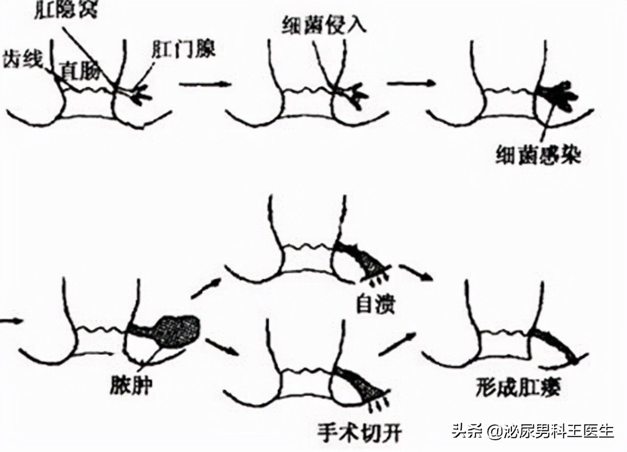 肛瘘患者：“不想治了，我真的太痛了！”肛瘘手术到底有多痛？