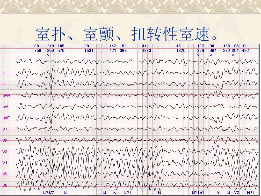 1份30元的心电图，可直接诊断出5种常见心脏病，辅助诊断4种病