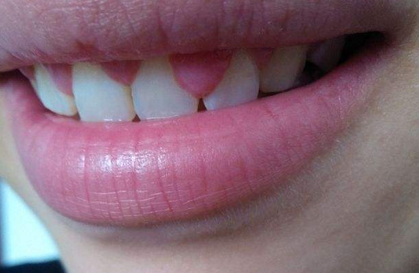 牙龈上长了个瘤子怎么办？不疼不痒会影响健康吗？听听牙医怎么说