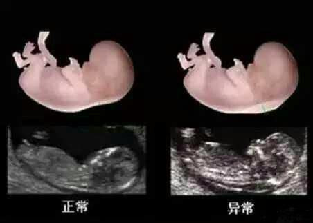 nt是什么意思（NT检查的必要性一文讲解）