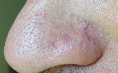 ▼毛细血管扩张表现毛细血管每个人都有,只不过有的人深藏不露看不见