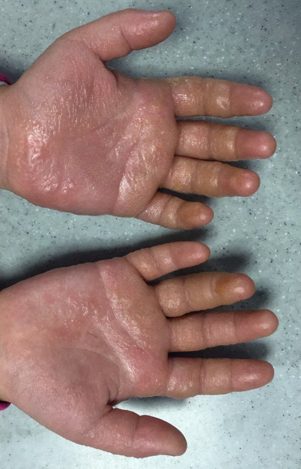 10岁女孩玩后双手长水疱 医生:不排除加入特殊化学成分