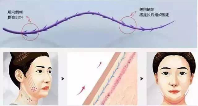 2020想要年轻貌美回家过年，线雕是明智的选择