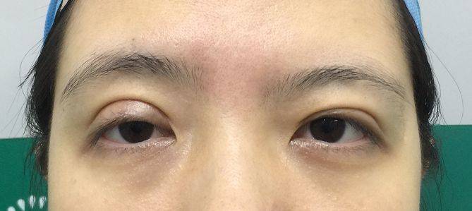 都是做双眼皮!眼修复怎么比初眼贵那么多?