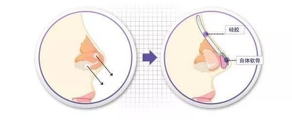 隆鼻术的术后需要注意什么？假体隆鼻可以一辈子吗？