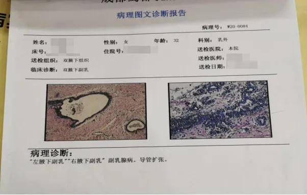 吊带衫、连衣裙因为它不敢穿？副乳到底是啥？出现了应该怎么办？