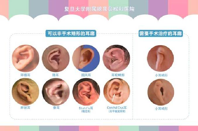 招风耳、精灵耳、杯状耳……先天性耳廓畸形可非手术矫正，有多少家长错过了？