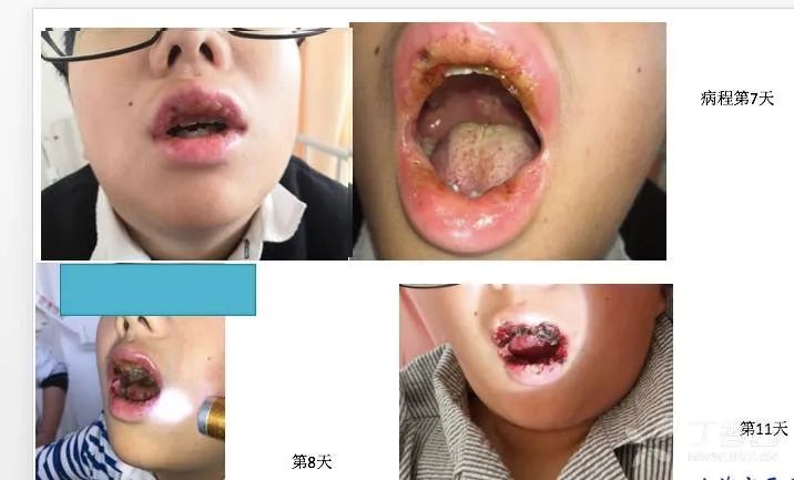 扁桃体化脓治疗方法