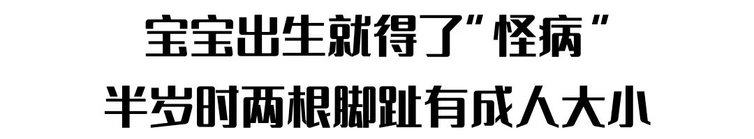 得了这病，半岁宝宝脚趾比香蕉还粗！做手术后，九成以上还可能复发