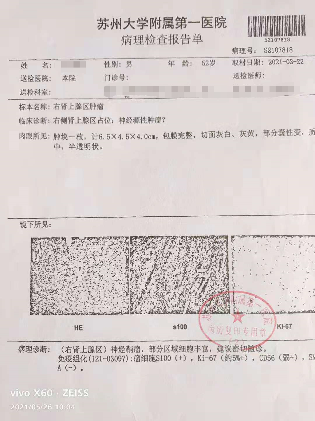 患者花5万切瘤后不理赔，太平洋保险：良性肿瘤不在保障范围