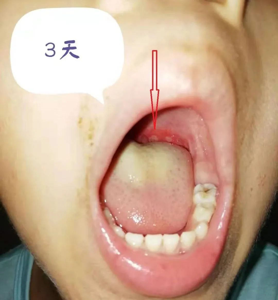 嘴里有疱疹，可不一定是疱疹性咽峡炎