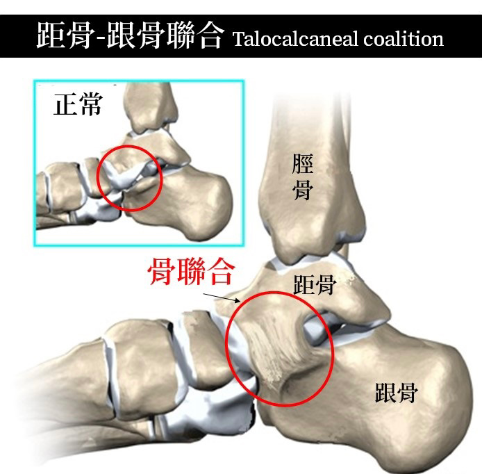 好多宝宝都有的问题，扁平足一定要治疗吗？会影响走路吗？