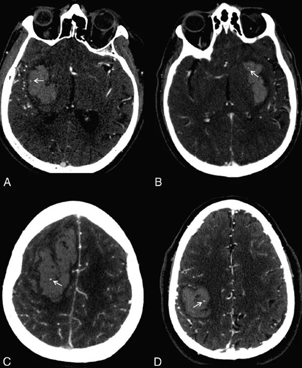 神经影像：CT上出现这些征象，警惕脑血肿扩大