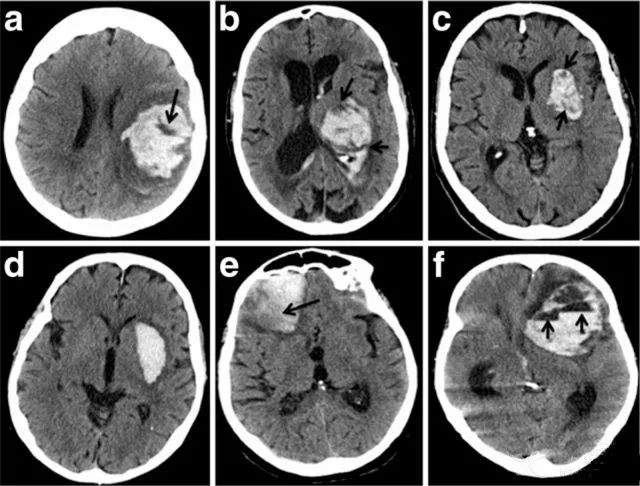 神经影像：CT上出现这些征象，警惕脑血肿扩大