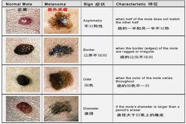 这种痣易“癌变”！宝宝身上有这5种痣，要立刻就医