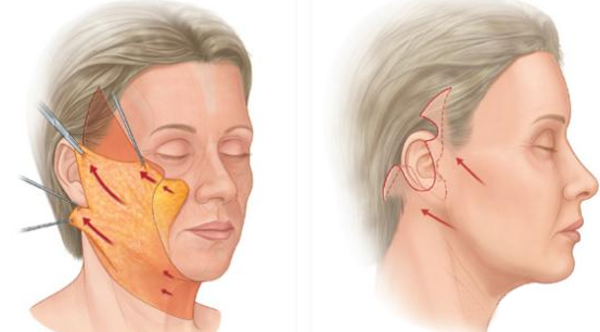 拉皮手术你了解多少？专业医生来解答！（附带真实案例解析）