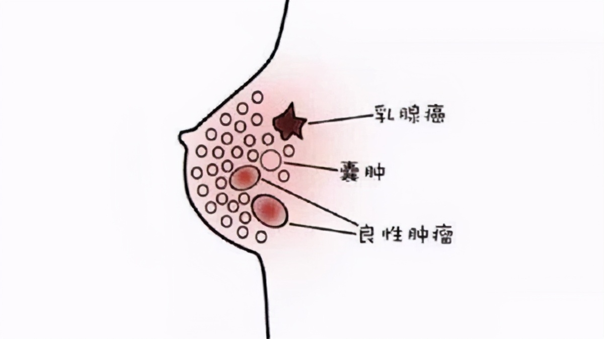 都是无痛性肿块,乳腺纤维瘤和乳腺癌区别在哪?