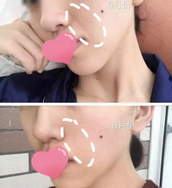让日本女人夜夜疯狂的神器，法令纹、眉间纹克星！一贴＝10次除皱