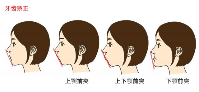 儿童矫牙大概要多少钱？你想知道的都在这里了