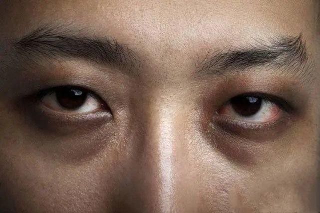 早期肝硬化,身体会浮现出9大症状,占一半以上,要及时就医