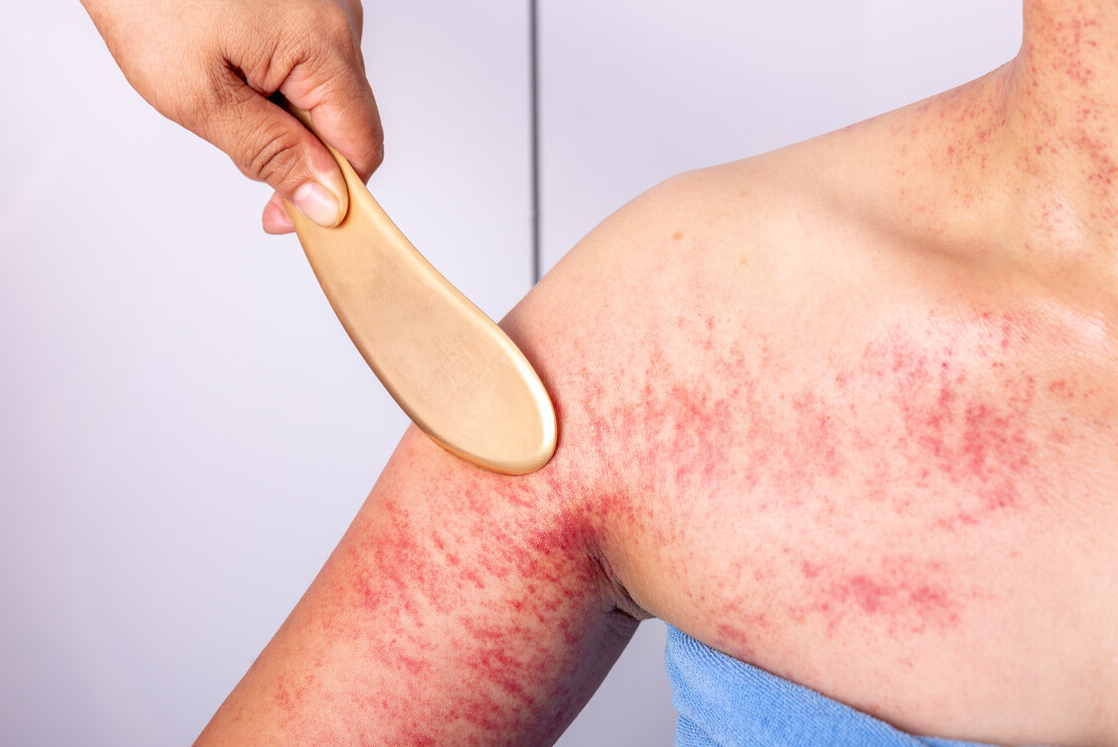 刮痧后一片红,这是把"毒"刮出来了吗?真的是颜色越深越好?