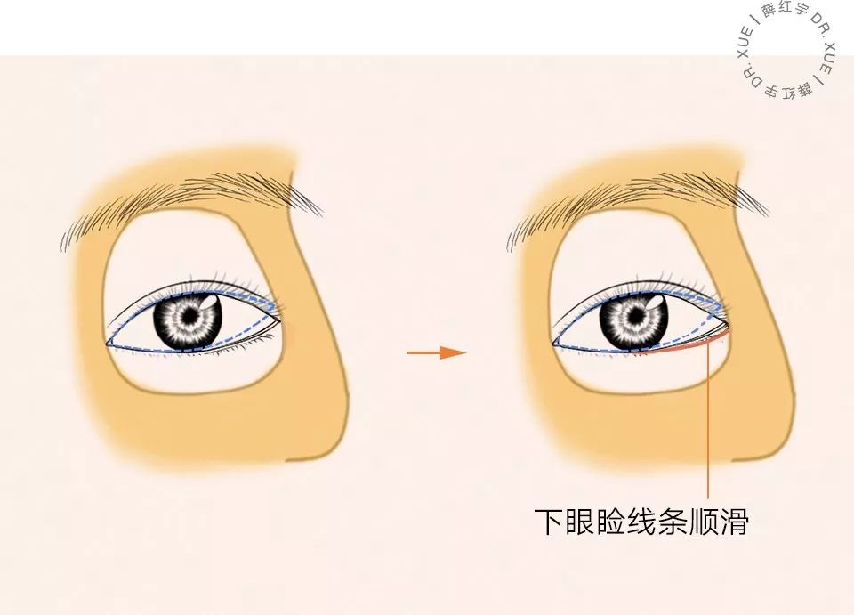 要不要开外眼角？要不要做眼睑下至？