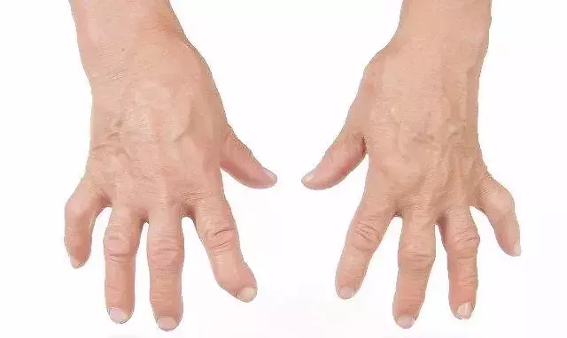 手指肿痛怎么办？快速缓解手指疼痛的有效方法