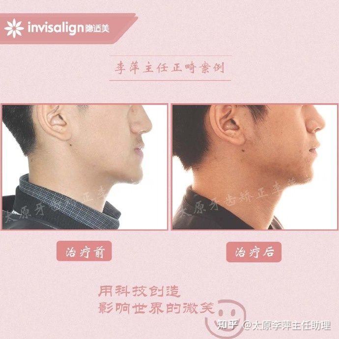 太原牙齿矫正：隐形牙套效果好不好？看这些病例你就知道了