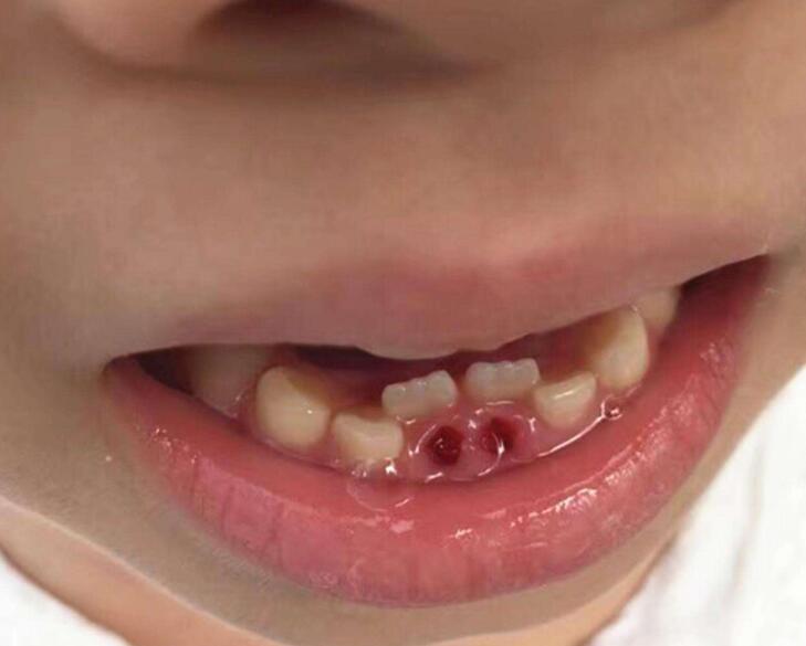 父母晒孩子双排牙齿,还以为是孩子"发育好",网友:赶紧送医院