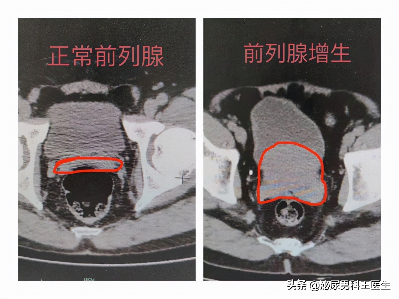 中老年人得了前列腺增生应该怎么办？