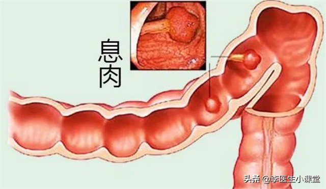 医生提醒：肠息肉切除后，饮食上做到这几点，伤口好得更快