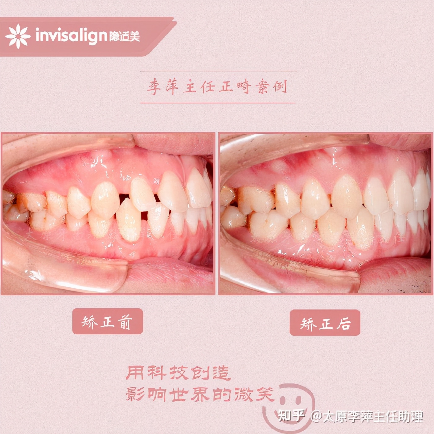 太原牙齿矫正：隐形牙套效果好不好？看这些病例你就知道了