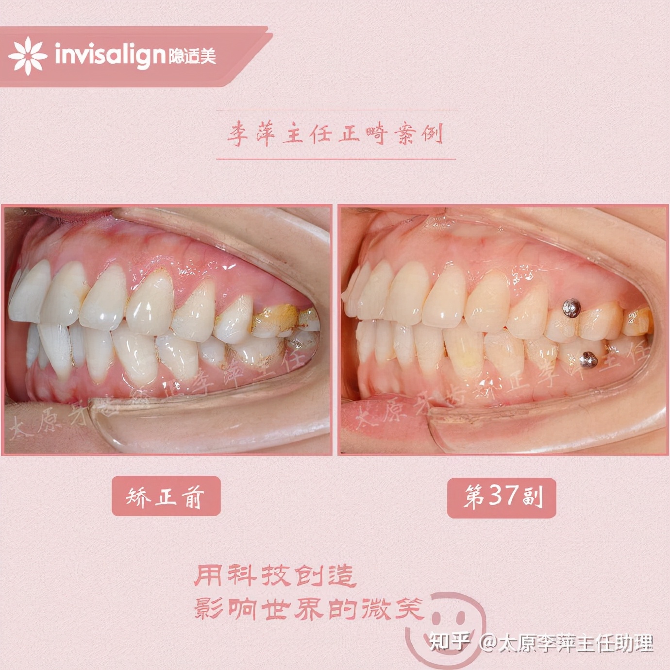 太原牙齿矫正：隐形牙套效果好不好？看这些病例你就知道了