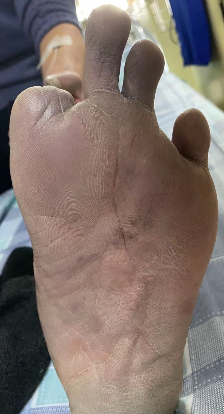 带你认识血栓闭塞性血管炎