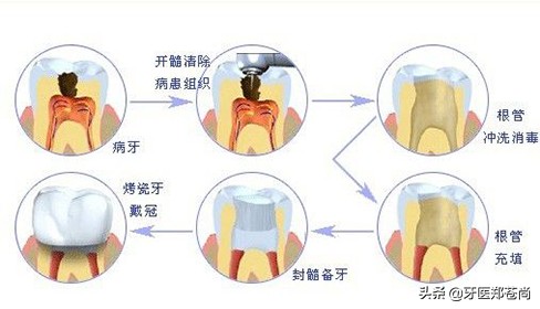 根管治疗是在牙齿上做了什么？根管治疗后牙齿还能用多久？