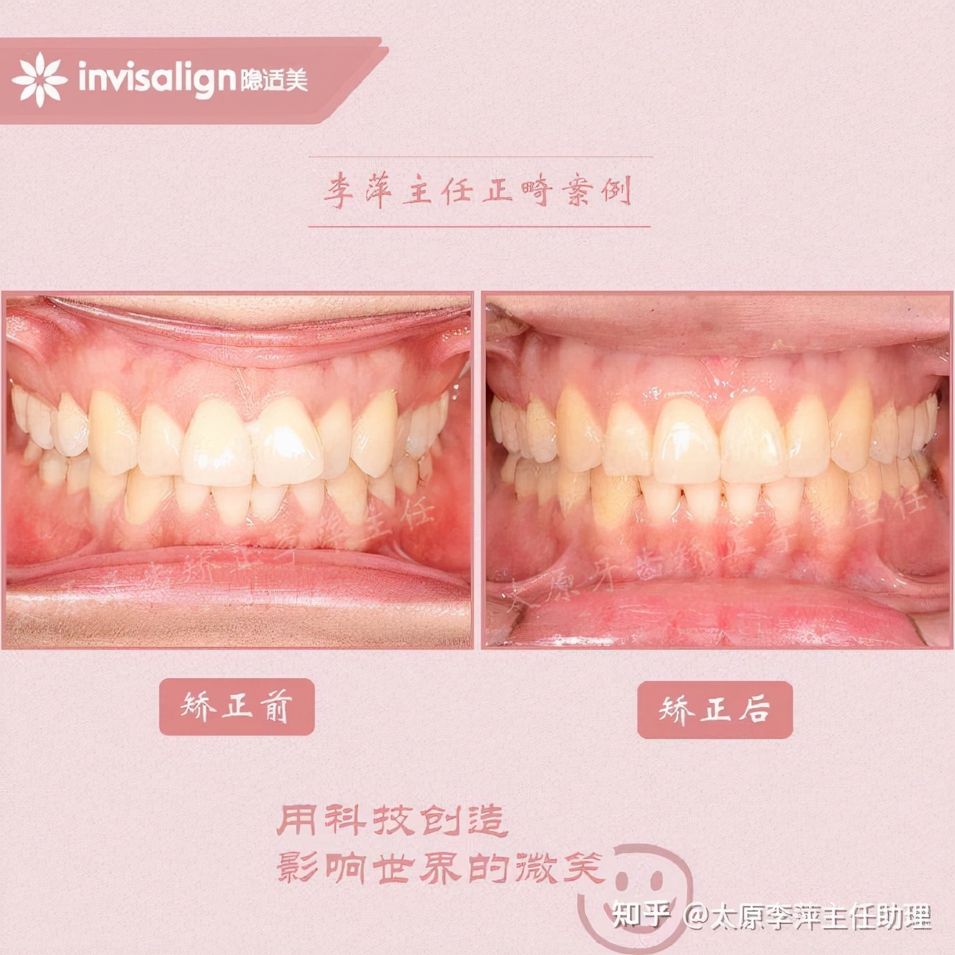 太原牙齿矫正：隐形牙套效果好不好？看这些病例你就知道了