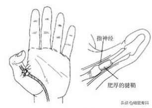 婴儿腱鞘炎怎么引起的（宝宝拇指伸不直）