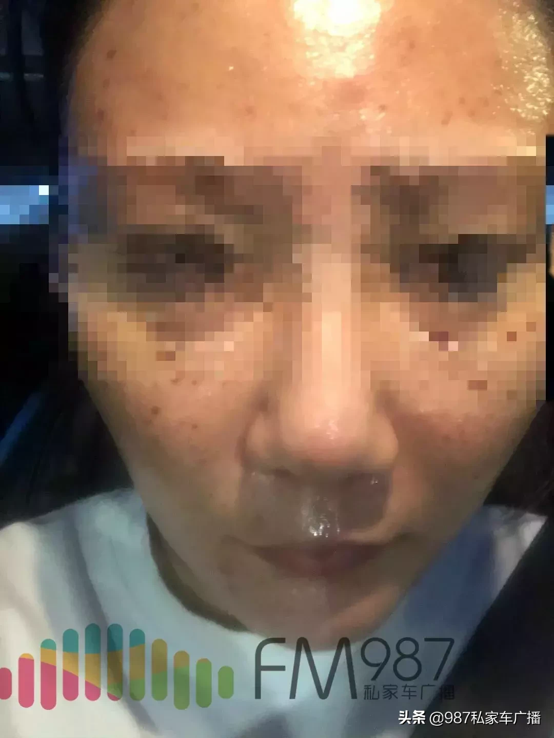 坑!福州徐小姐花1万7做美容,结果脸僵了....