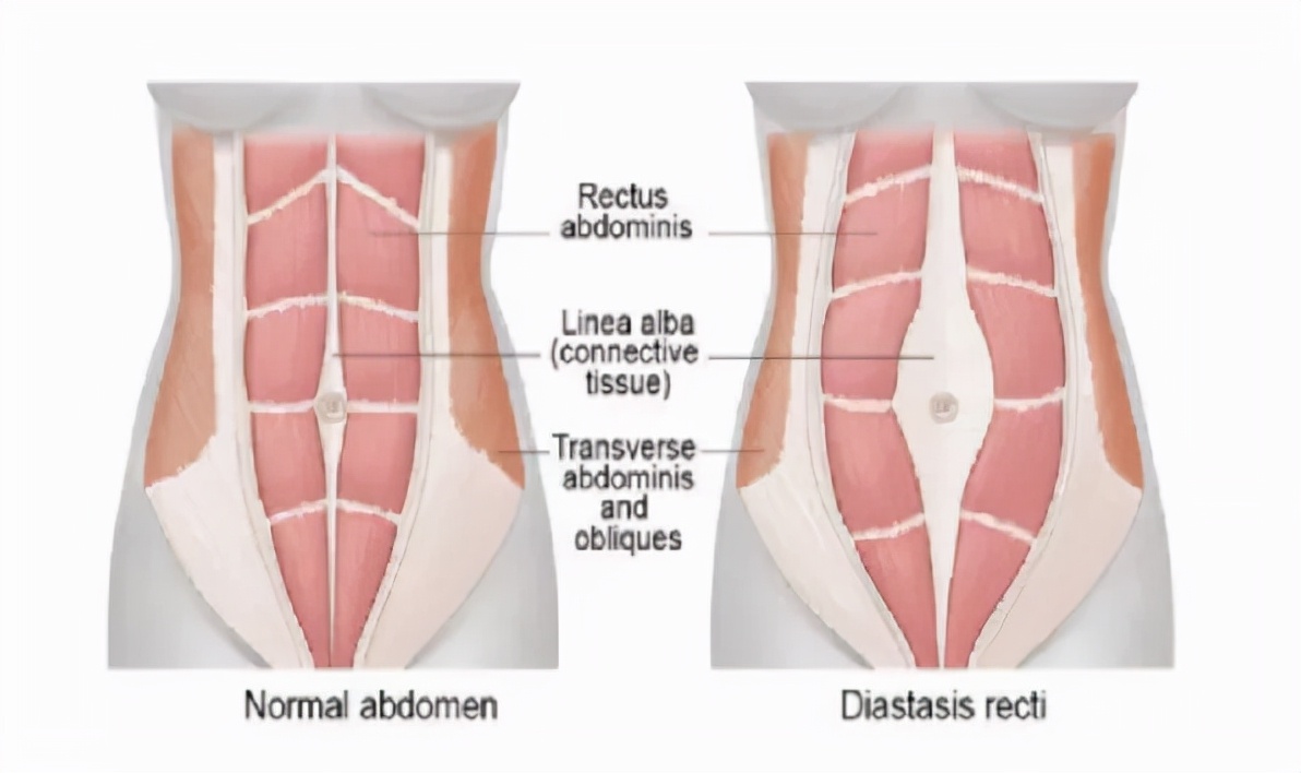 产后漏尿、大肚腩，该如何修复？在家可以这样做