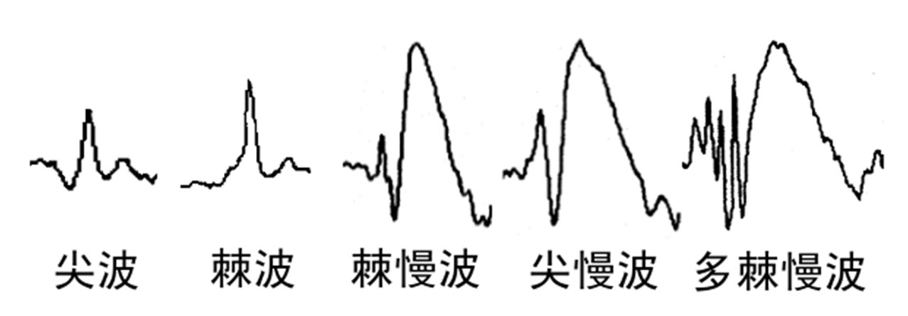 神经科医生和你聊聊脑电图那些事儿