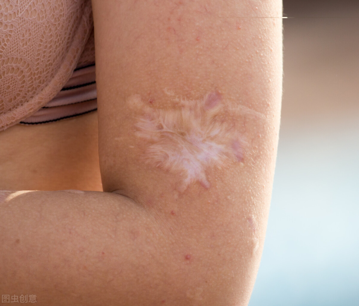 涂牙膏、抹猪油、敷蛋清、铺面粉？你真的知道怎样处理烧烫伤吗？