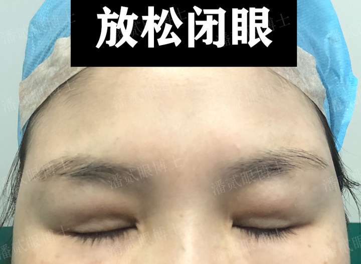 不合格填充脂肪带来的反效果：变肿眼泡、眼皮鼓包、凹凸不平