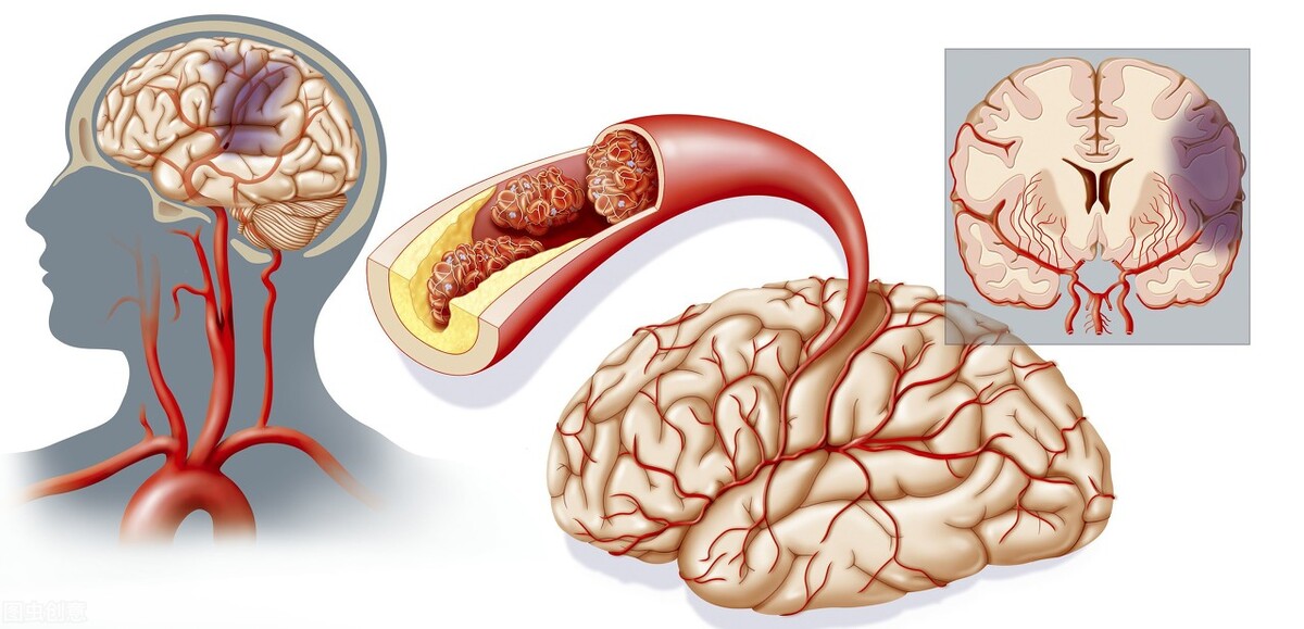 脑血管造影能检查什么？这6种情况，建议做脑血管造影