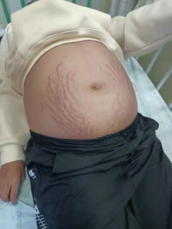 13岁女孩右下腹疼痛可能原因解析